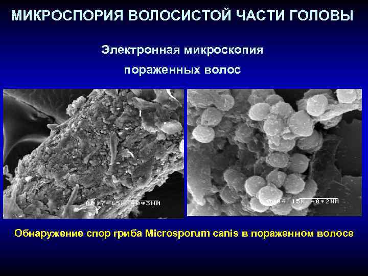 На коже обнаружены споры. Микроспорум Канис микроскопия. Поверхностная трихофития микроскопия.
