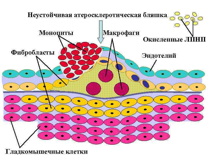 Неустойчивая атеросклеротическая бляшка Моноциты Фибробласты Гладкомышечные клетки Макрофаги Окисленные ЛПНП Эндотелий 