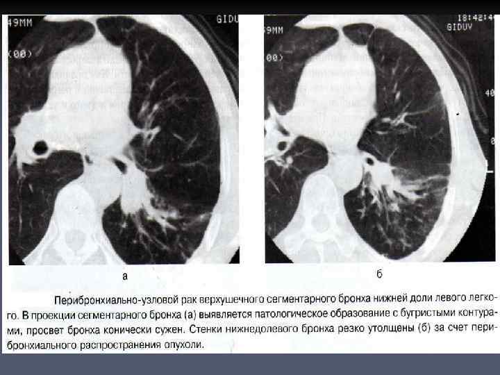 Злокачественная опухоль картинки