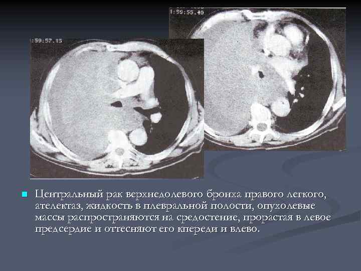 Центральный рак легкого картинки