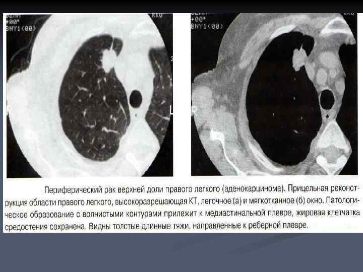 Злокачественная опухоль картинки