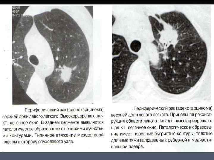 Периферический рак верхней доли. Периферическая опухоль верхней доли правого легкого.