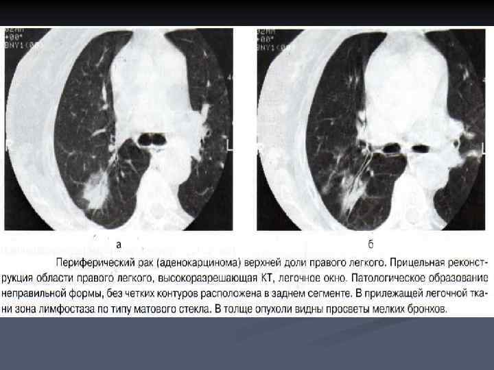 Рак нижней доли. Бронхоальвеолярная карцинома на кт. Периферическая опухоль верхней доли правого легкого. Объемные образования в легких на кт.
