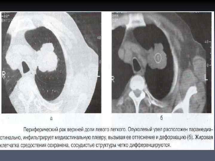 Злокачественная опухоль картинки