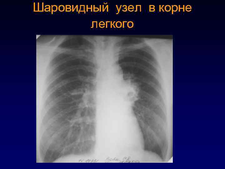 Шаровидный узел в корне легкого 