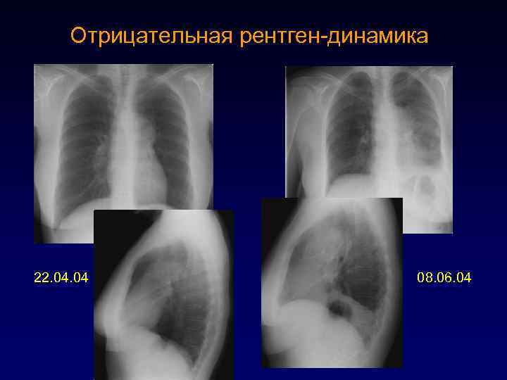 Отрицательная рентген-динамика 22. 04 08. 06. 04 