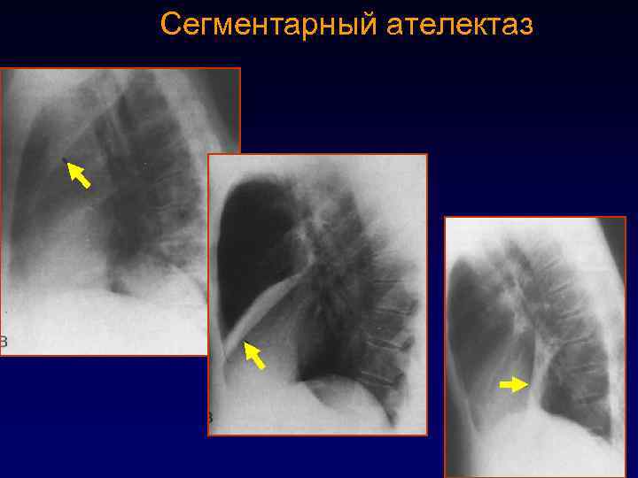 Ателектазы рентген схема