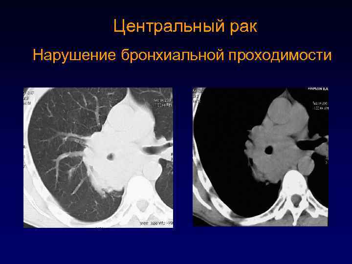 Центральный рак Нарушение бронхиальной проходимости 