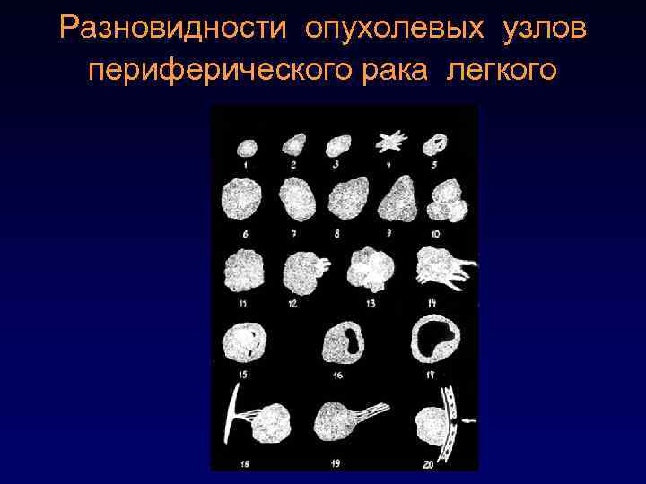 Разновидности опухолевых узлов периферического рака легкого 