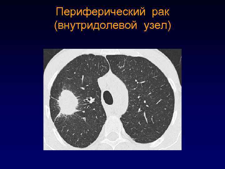 Лучевая диагностика рака легкого презентация