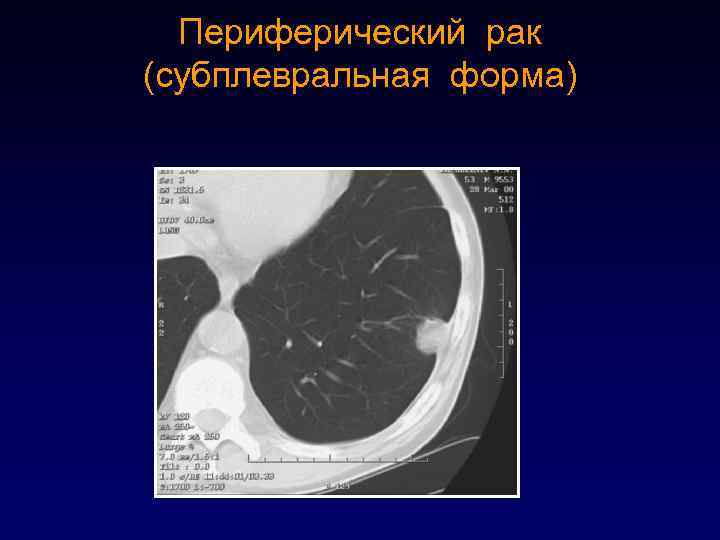 Субплевральные солидные
