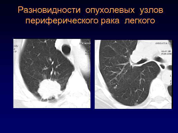 Разновидности опухолевых узлов периферического рака легкого 