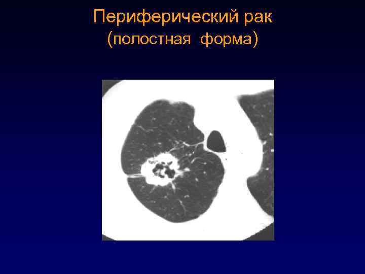 Центральный рак кт. Полостное образование легкого кт. Периферическая карцинома легких кт.