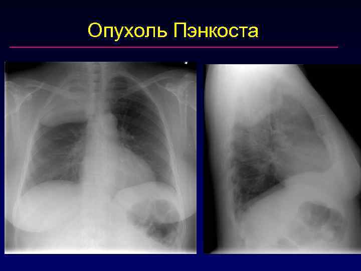 Опухоль Пэнкоста 