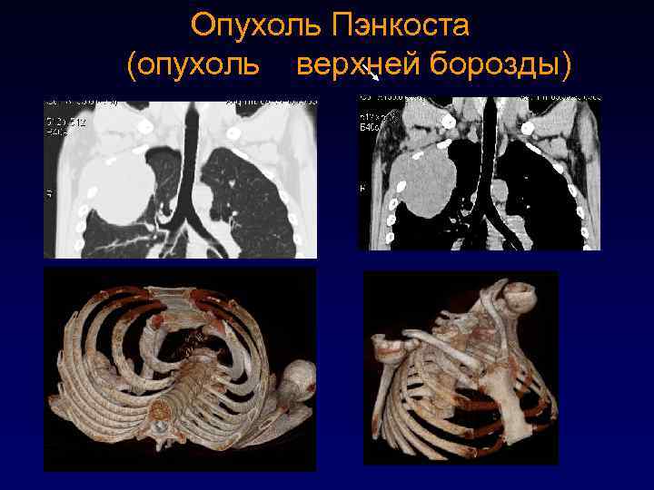 Опухоль Пэнкоста (опухоль верхней борозды) 