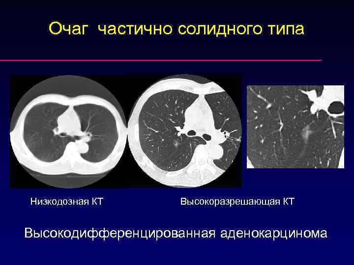 Очаг частично солидного типа Низкодозная КТ Высокоразрешающая КТ Высокодифференцированная аденокарцинома 