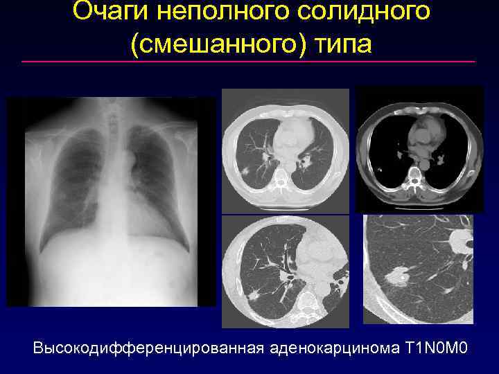 Очаги неполного солидного (смешанного) типа Высокодифференцированная аденокарцинома T 1 N 0 M 0 