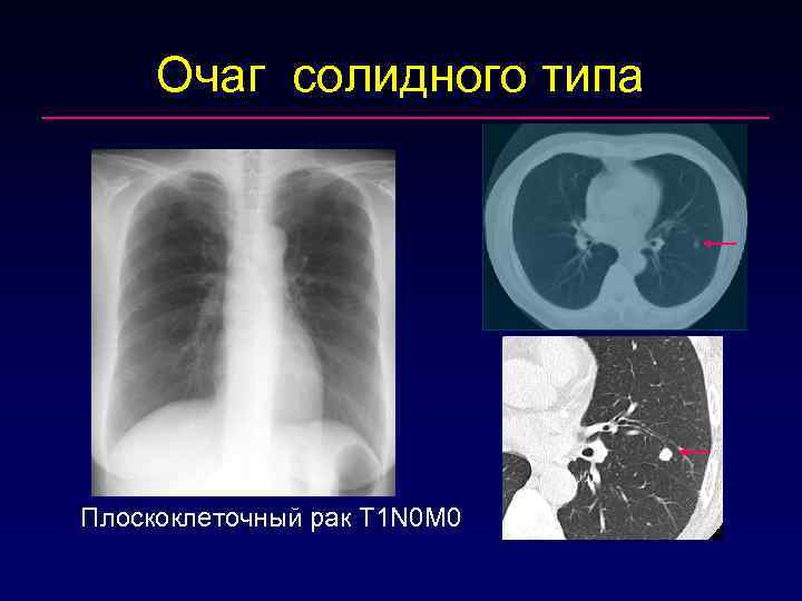 Единичные солидные очаги в легких. Солидные очаги в легких на кт. Солидный очаг в легком.