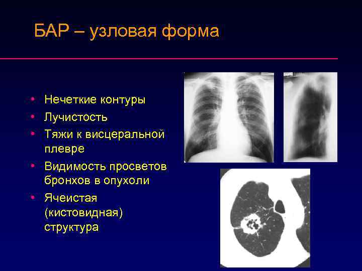 БАР – узловая форма • Нечеткие контуры • Лучистость • Тяжи к висцеральной плевре