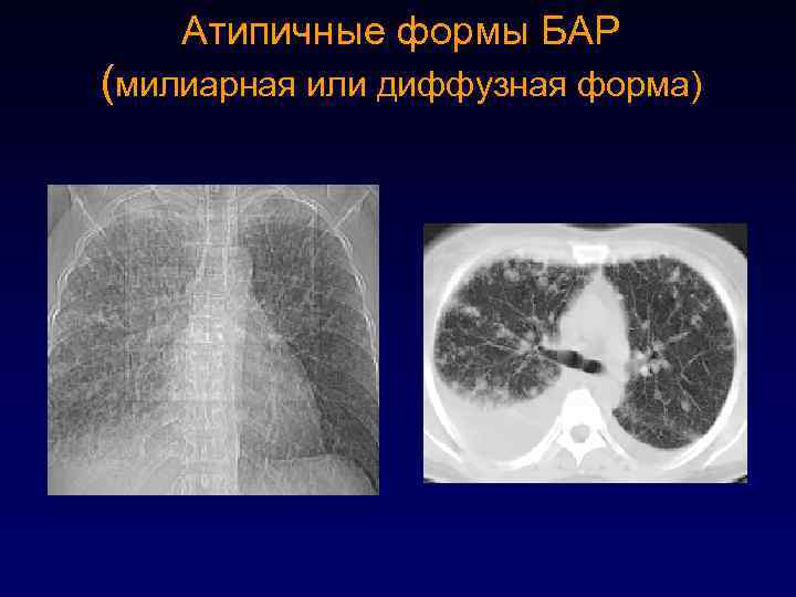 Атипичные формы БАР (милиарная или диффузная форма) 