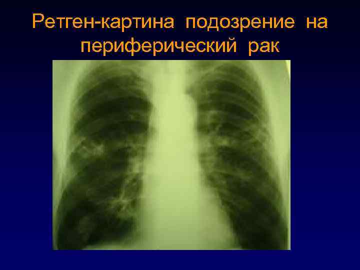 Ретген-картина подозрение на периферический рак 