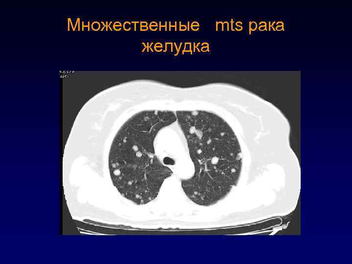 Множественные mts рака желудка 