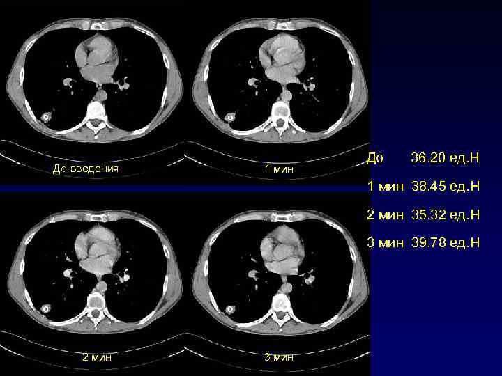 До введения 1 мин До 36. 20 ед. H 1 мин 38. 45 ед.