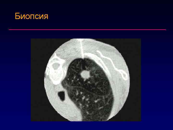 Биопсия 