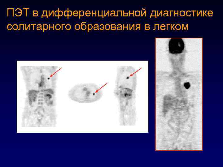 ПЭТ в дифференциальной диагностике солитарного образования в легком 