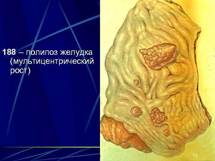 188 – полипоз желудка  (мультицентрический  рост)     13 