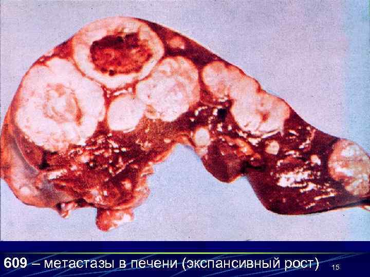 609 – метастазы в печени (экспансивный рост)  15 