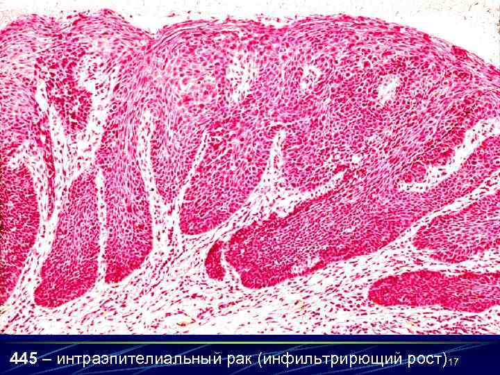 445 – интраэпителиальный рак (инфильтрирющий рост) 17 