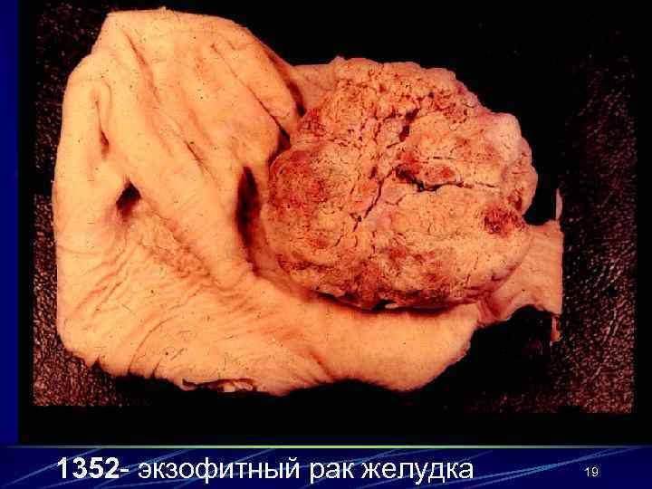 1352 - экзофитный рак желудка  19 