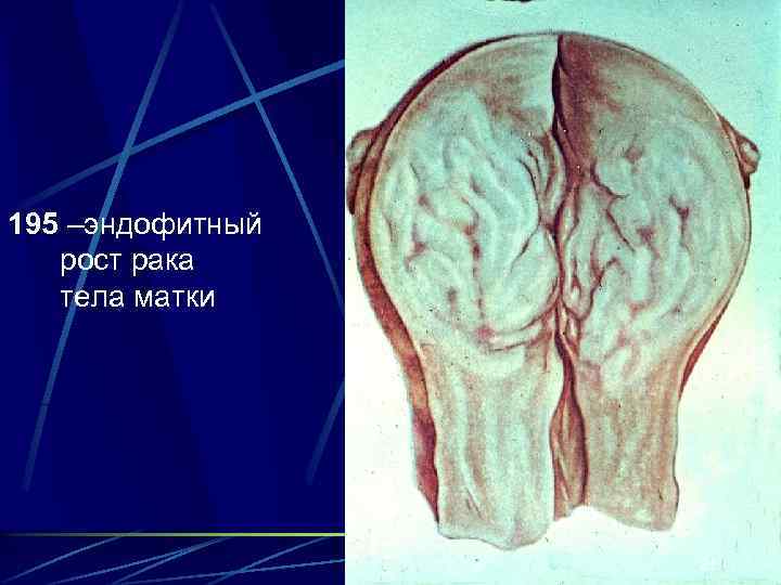 195 –эндофитный  рост рака  тела матки    21 