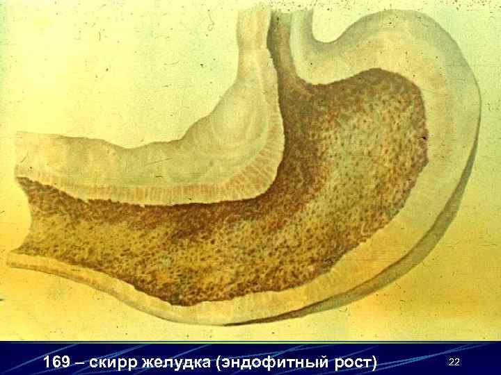 169 – скирр желудка (эндофитный рост)  22 