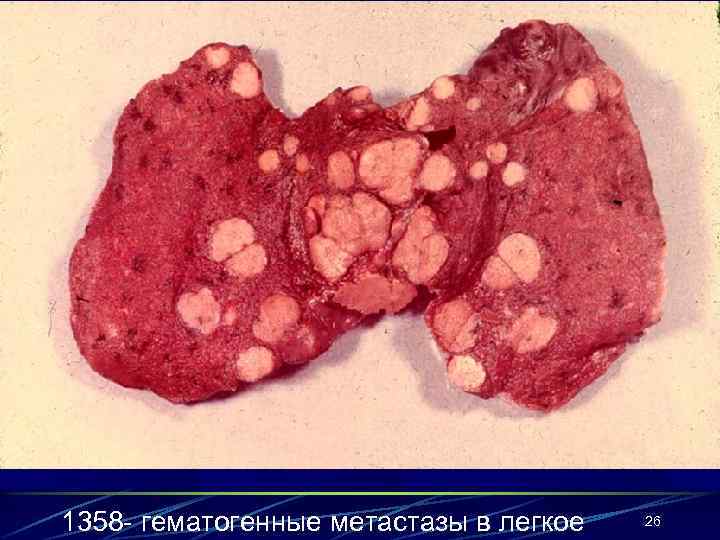 1358 - гематогенные метастазы в легкое  26 
