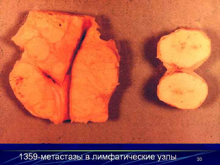 1359 -метастазы в лимфатические узлы  30 