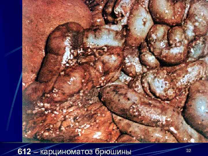 612 – карциноматоз брюшины  32 