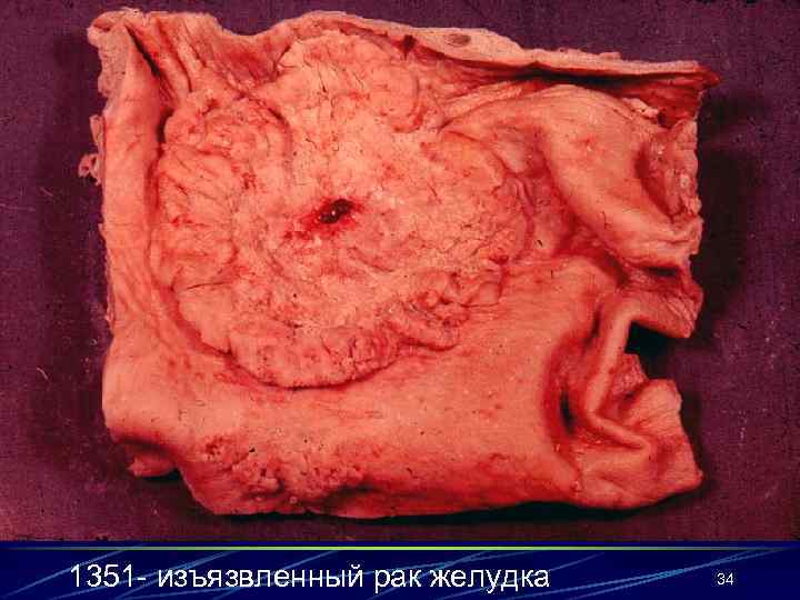 1351 - изъязвленный рак желудка  34 