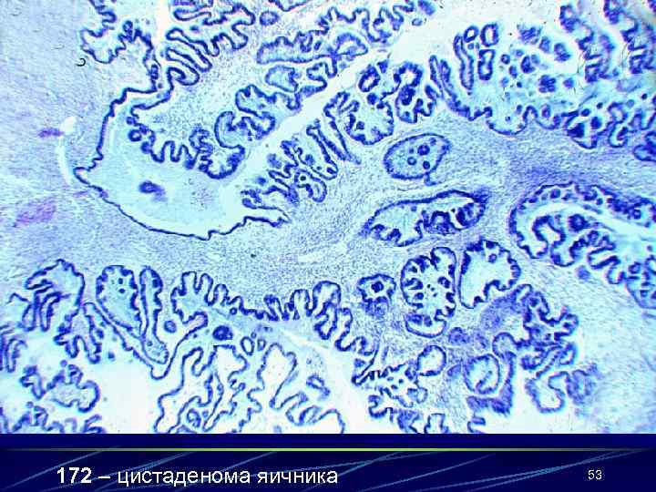 172 – цистаденома яичника  53 