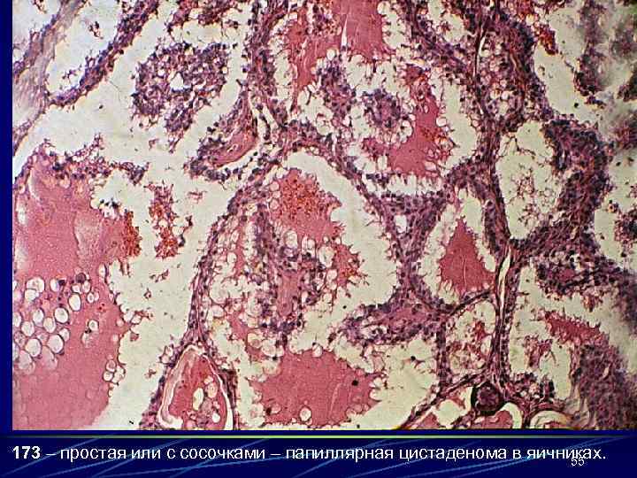 173 – простая или с сосочками – папиллярная цистаденома в яичниках.   