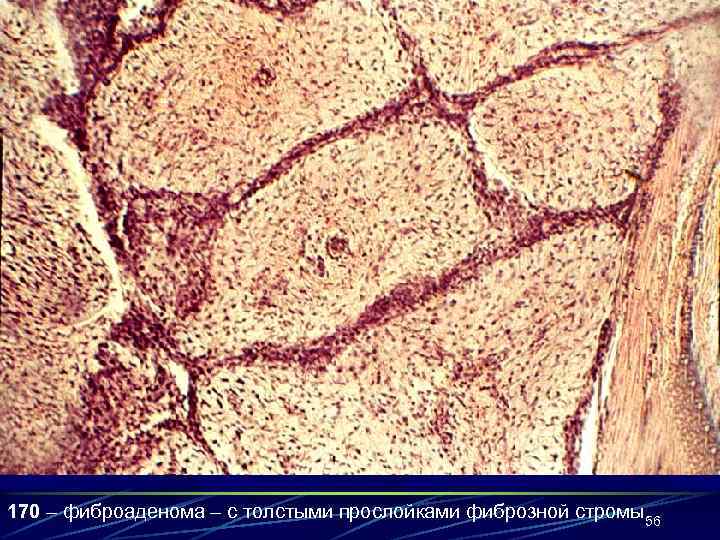 170 – фиброаденома – с толстыми прослойками фиброзной стромы.     