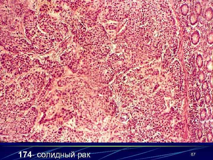 174 - солидный рак  67 