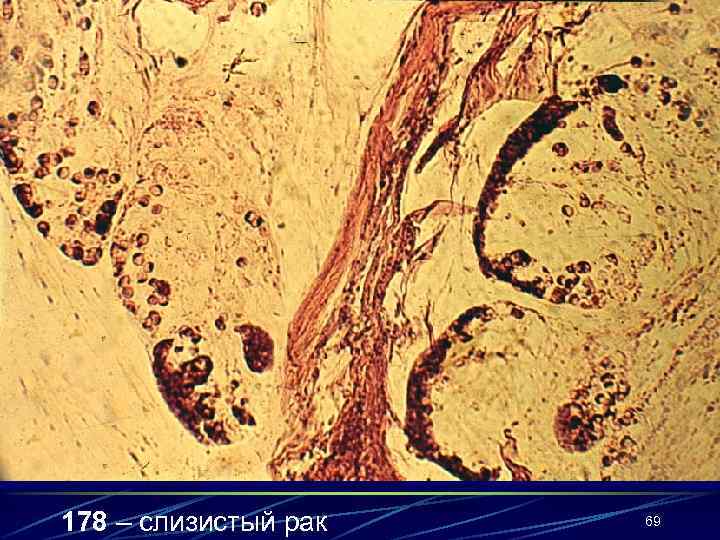 178 – слизистый рак  69 