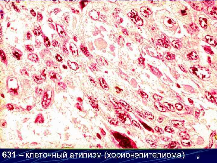631 – клеточный атипизм (хорионэпителиома)  9 
