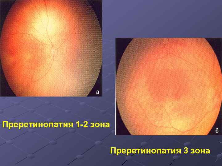 Преретинопатия 1 2 зона Преретинопатия 3 зона 