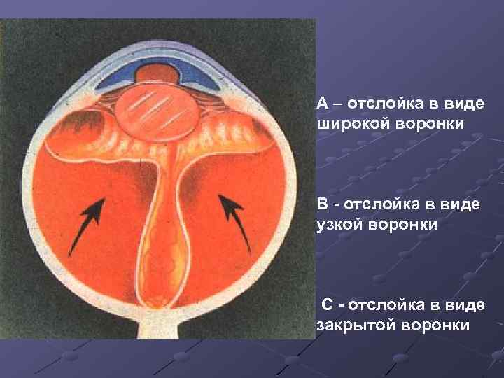 А – отслойка в виде широкой воронки В отслойка в виде узкой воронки С