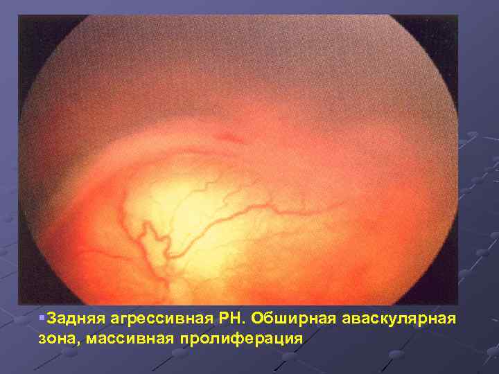 §Задняя агрессивная РН. Обширная аваскулярная зона, массивная пролиферация 