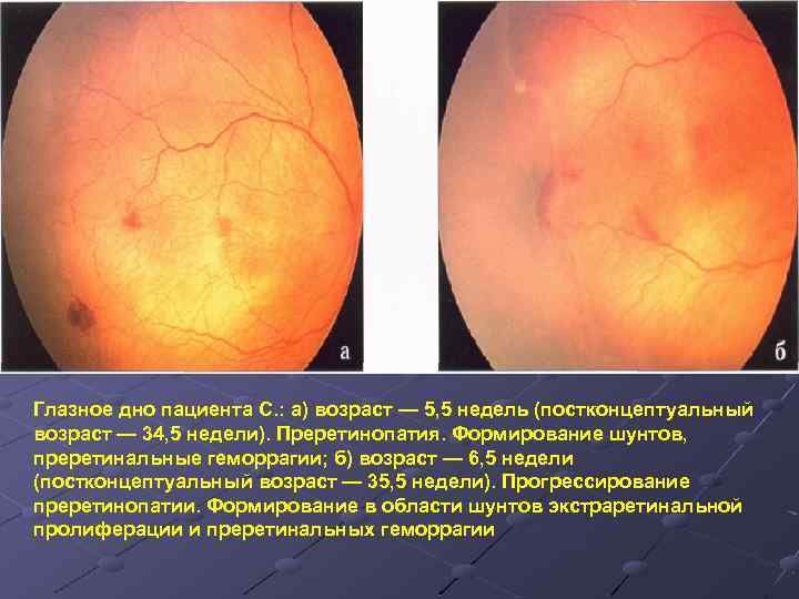 Глазное дно пациента С. : а) возраст — 5, 5 недель (постконцептуальный возраст —