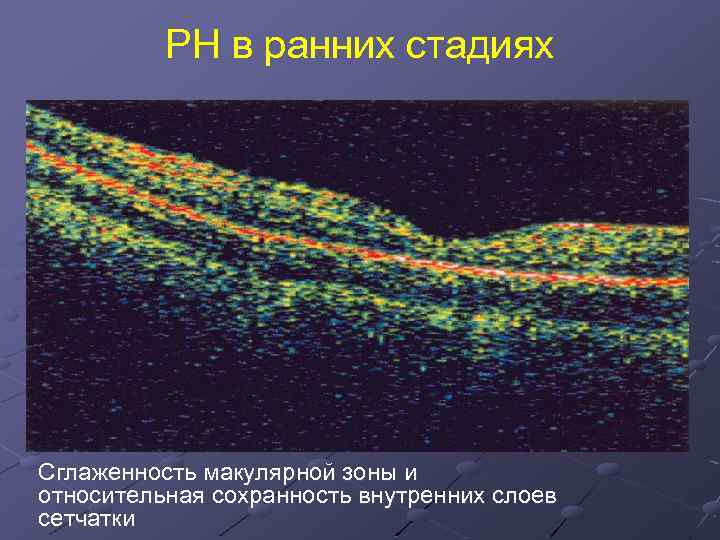 РН в ранних стадиях Сглаженность макулярной зоны и относительная сохранность внутренних слоев сетчатки 